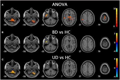 Altered Patterns of the Fractional Amplitude of Low-Frequency Fluctuation in Drug-Naive First-Episode Unipolar and Bipolar Depression